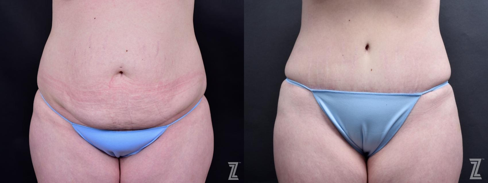 Austin Tummy Tuck Before & After Gallery - Patient 132886803 - Image 1 - The Piazza Center