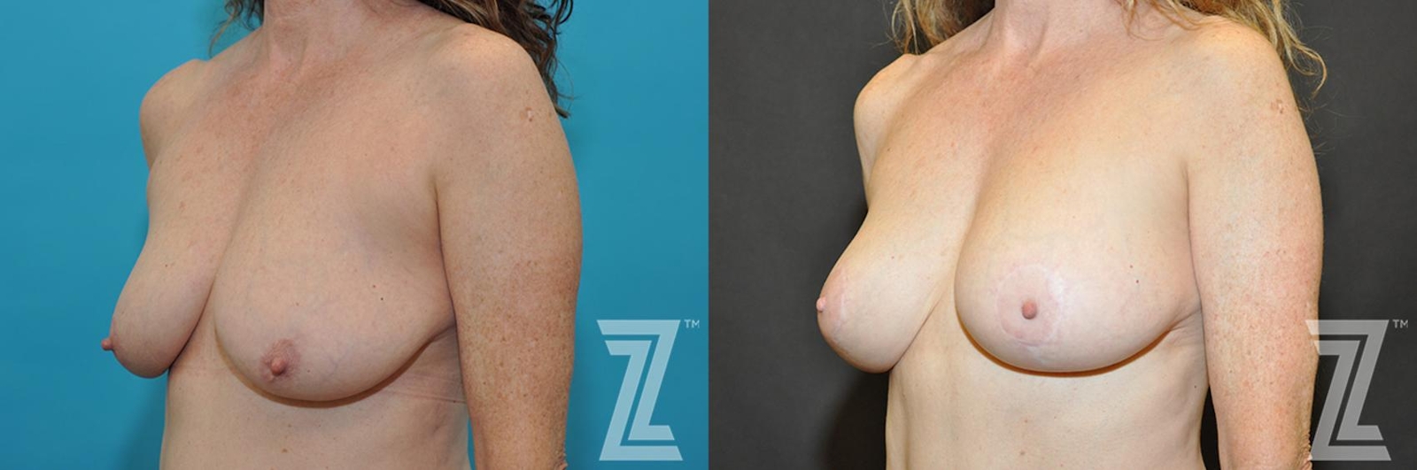 Austin Breast Augmentation With a Breast Lift Before & After Gallery - Patient 132791131 - Image 2 - The Piazza Center