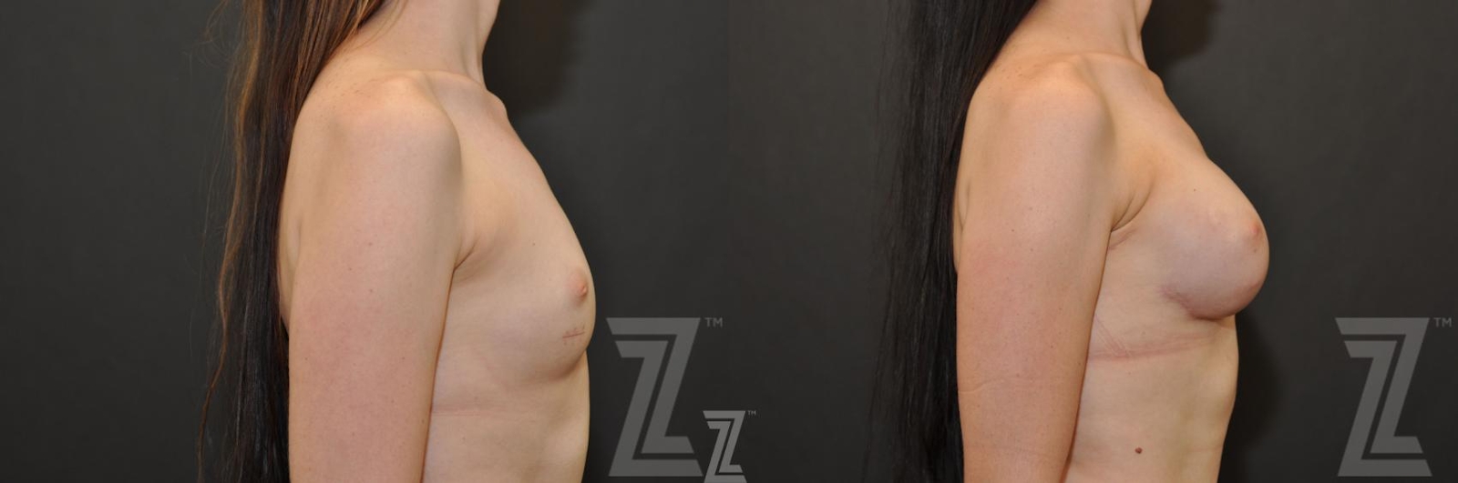 Austin Breast Reconstruction Before & After Gallery - Patient 132886774 - Image 5 - The Piazza Center