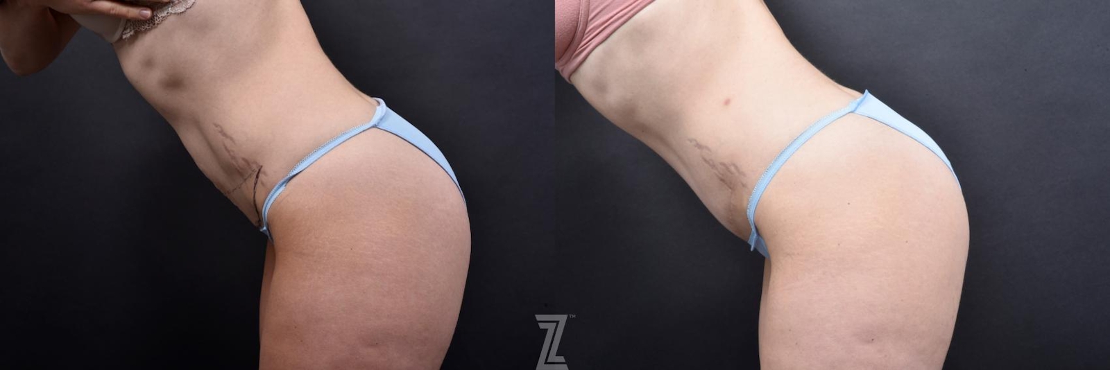 Austin Tummy Tuck Before & After Gallery - Patient 132886798 - Image 3 - The Piazza Center