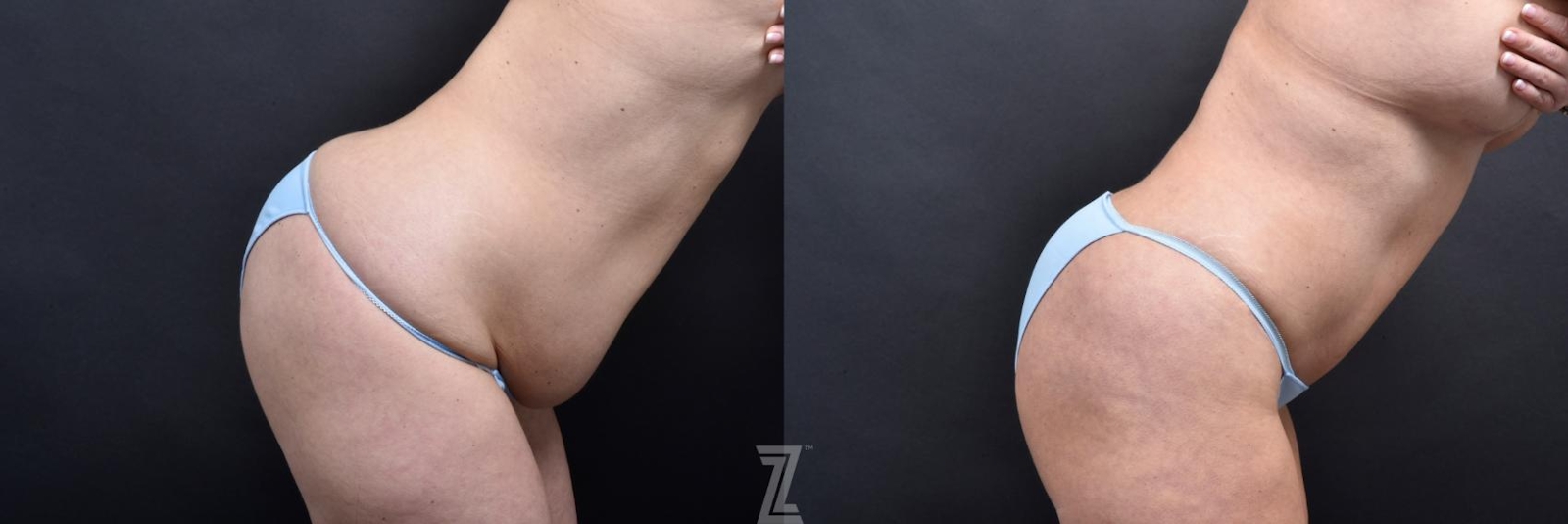 Austin Flexion Oblique View from Mommy Makeover of 41 year old woman in Austin, TX by Dr. Rocco Piazza - Before & After - The Piazza Center