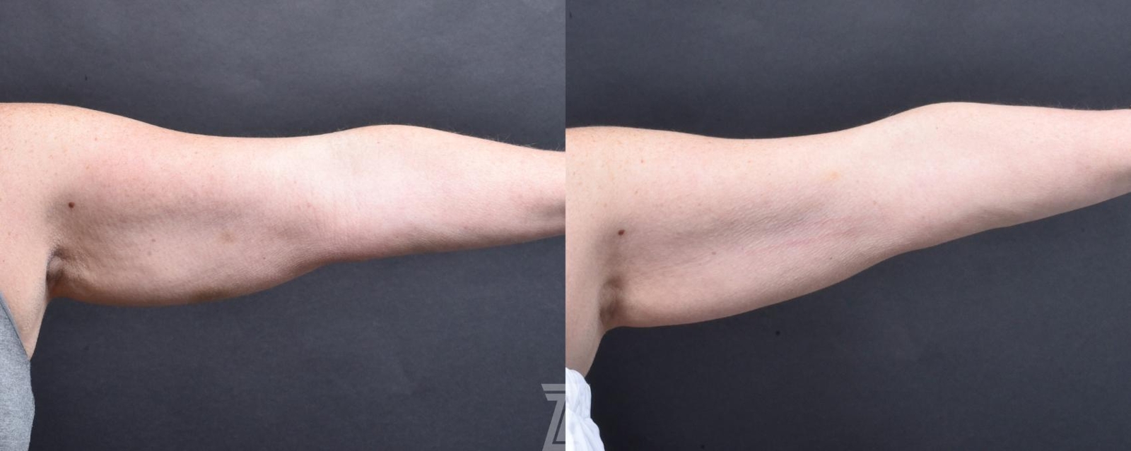 Austin Profound® RF Microneedling Before & After Gallery - Patient 132963577 - Image 4 - The Piazza Center