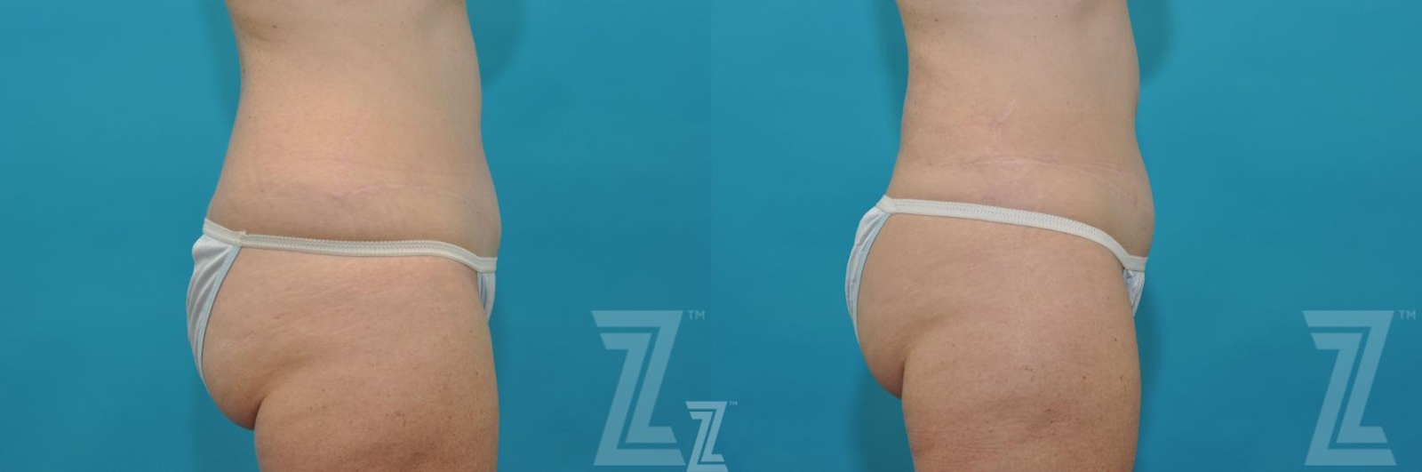 Austin Liposuction Before & After Gallery - Patient 132887304 - Image 4 - The Piazza Center