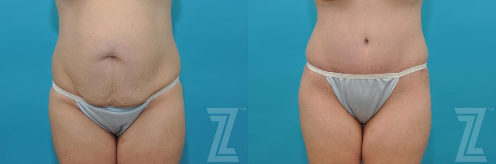 Austin Tummy Tuck Before & After Gallery - Patient 132886822 - Image 1 - The Piazza Center