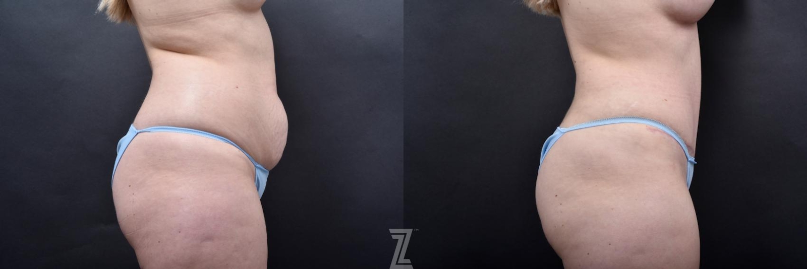 Austin Lateral View of Abdomen of 29-Year-Old Mommy Makeover Before & After by Dr. Rocco Piazza in Austin, Texas - The Piazza Center