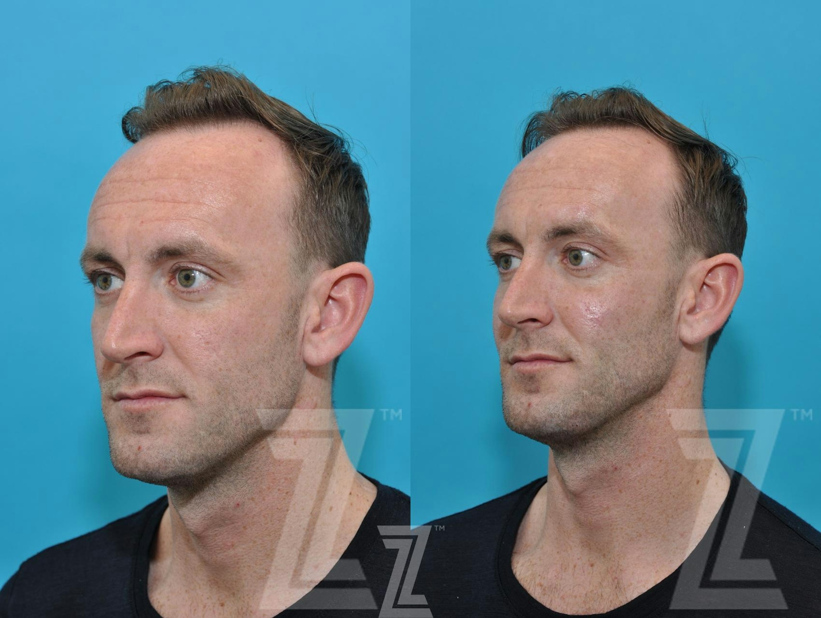 Austin Injectable Fillers Before & After Gallery - Patient 132963102 - Image 5 - The Piazza Center