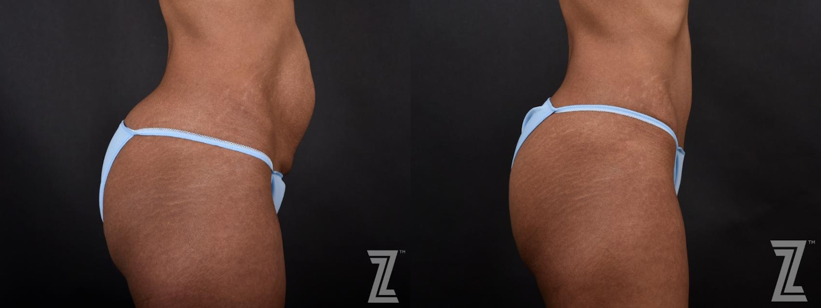 Austin Lateral View of Abdomen of 34-Year-Old Mom with Three Children Mommy Makeover Before & After by Dr. Rocco Piazza in Austin, Texas - The Piazza Center