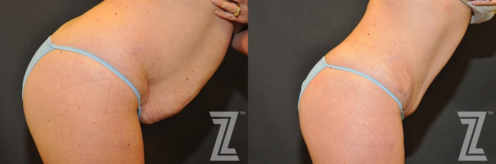Austin Tummy Tuck Before & After Gallery - Patient 132886883 - Image 5 - The Piazza Center