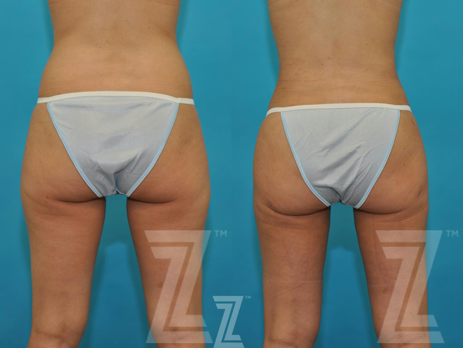 Austin Liposuction Before & After Gallery - Patient 132893822 - Image 3 - The Piazza Center