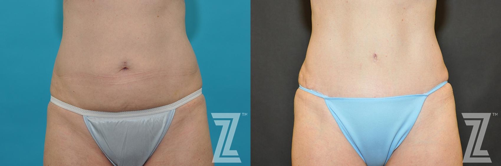 Austin Tummy Tuck Before & After Gallery - Patient 132886891 - Image 1 - The Piazza Center
