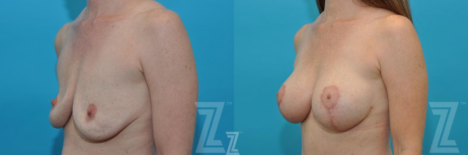 Austin Oblique Breast view before & after images of 35 year old woman mommy make over - Dr. Rocco Piazza Austin TX - The Piazza Center