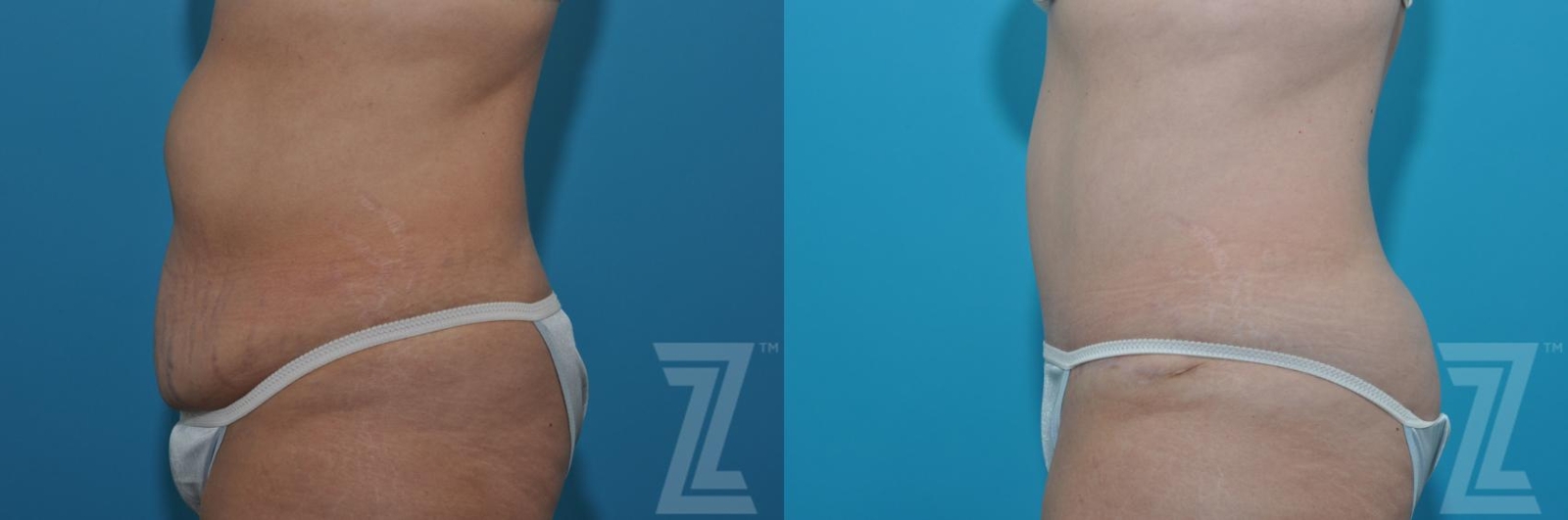 Austin Tummy Tuck Before & After Gallery - Patient 132886869 - Image 2 - The Piazza Center