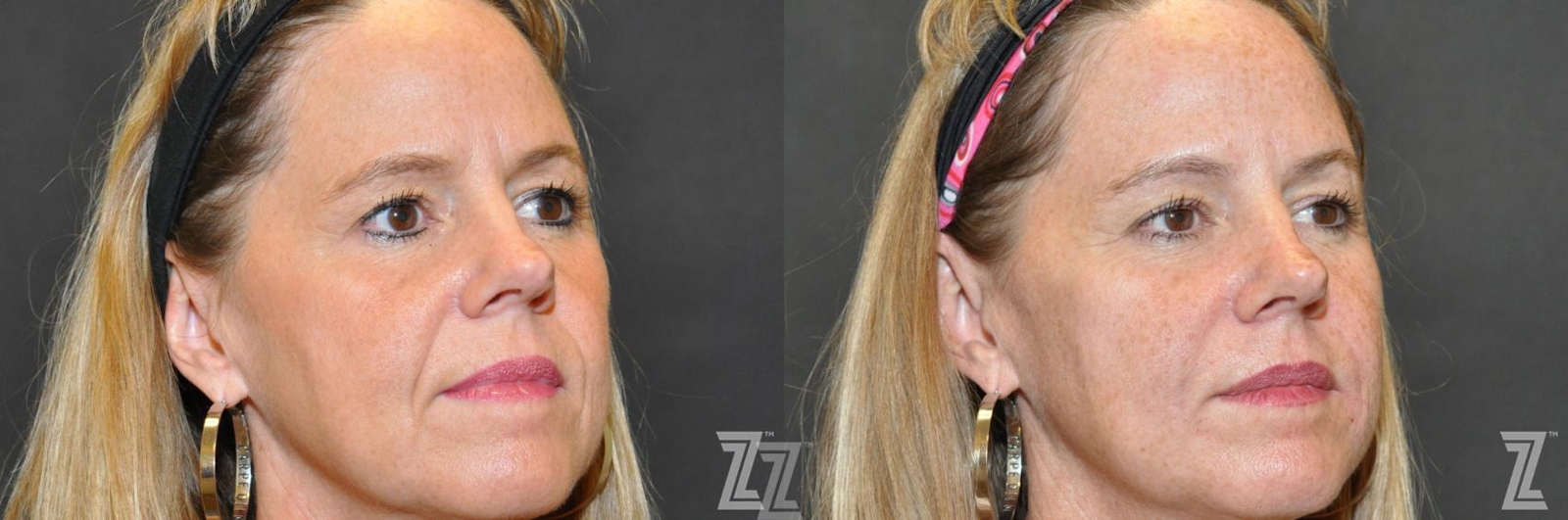 Austin Facial Rejuvenation Before & After Gallery - Patient 186050 - Image 2 - The Piazza Center