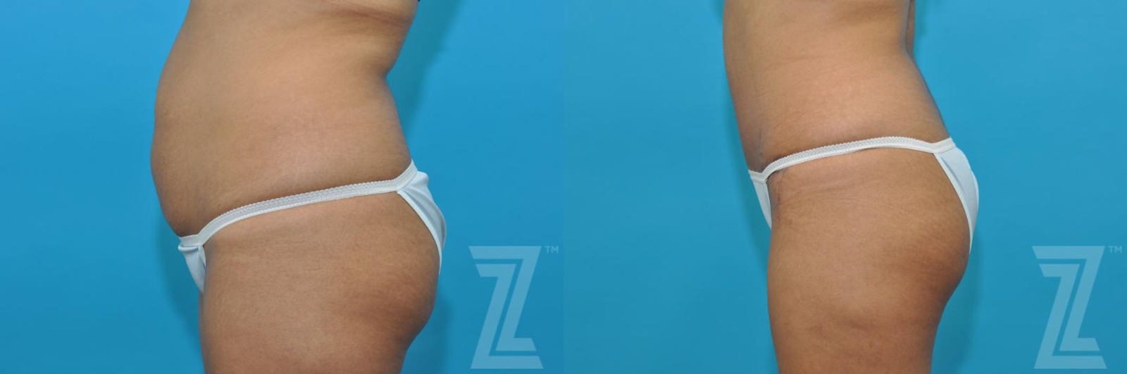 Austin Tummy Tuck Before & After Gallery - Patient 132886811 - Image 2 - The Piazza Center