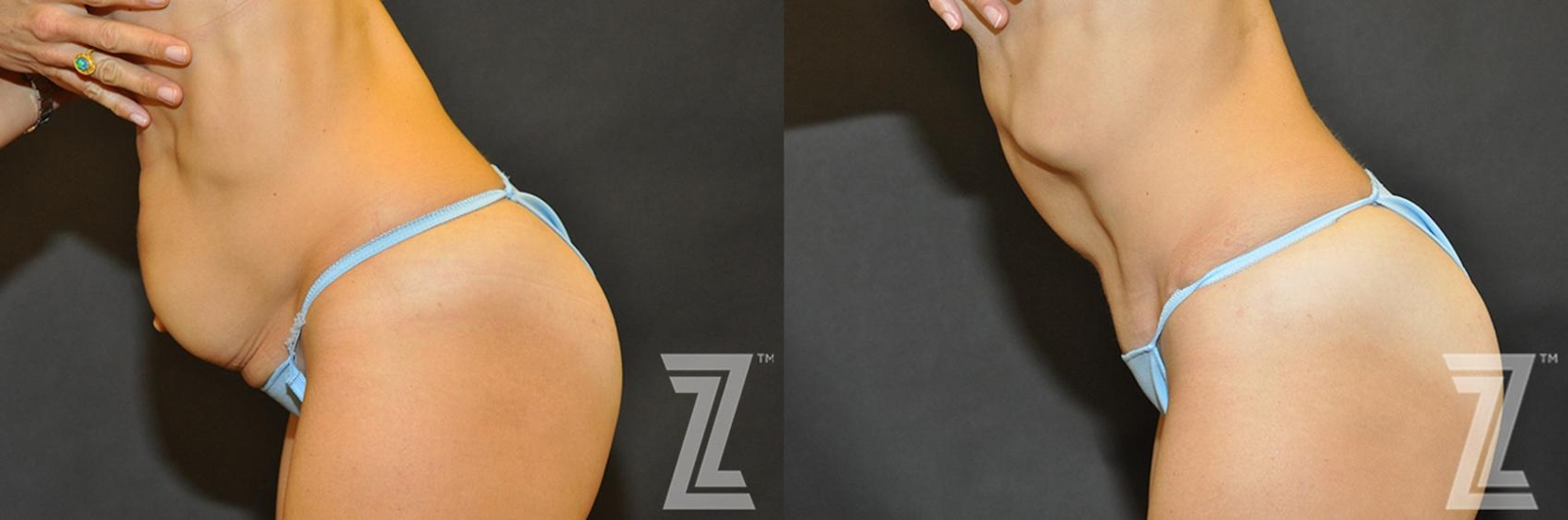 Austin Tummy Tuck Before & After Gallery - Patient 132886866 - Image 3 - The Piazza Center