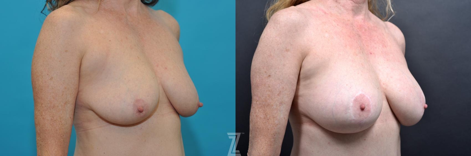Austin 7 year post op mommy makeover Oblique breast view - The Piazza Center, Austin Tx - The Piazza Center