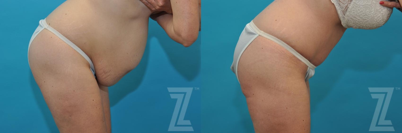 Austin Tummy Tuck Before & After Gallery - Patient 132886822 - Image 5 - The Piazza Center