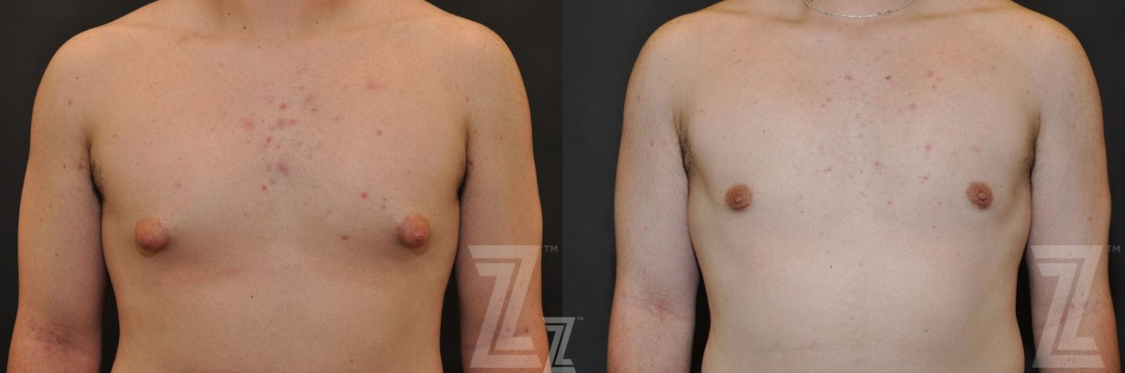 Austin Male Breast Reduction Before & After Gallery - Patient 132963597 - Image 1 - The Piazza Center