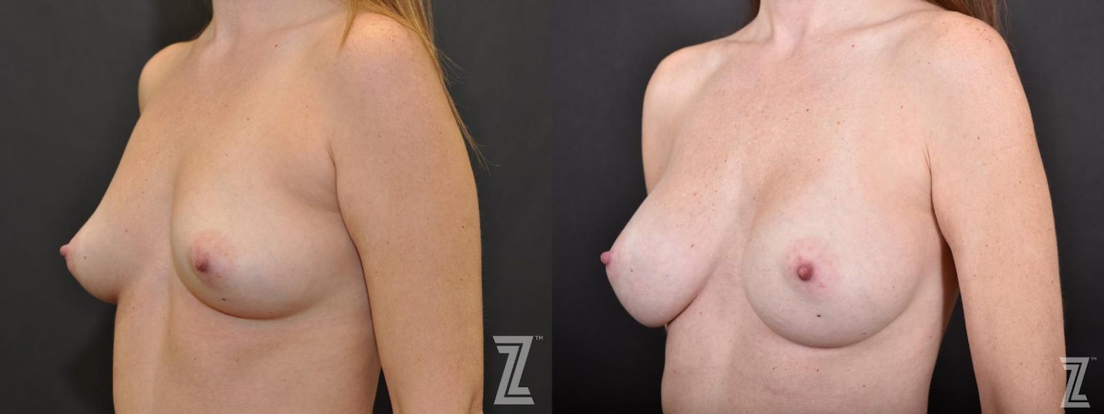 Austin Oblique View of before and after 33 year old women with Silicone Implants with Cohesive Silicone Gel at the Piazza center - The Piazza Center