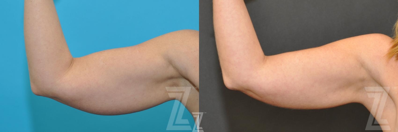 Austin CoolSculpting® Before & After Gallery - Patient 132905397 - Image 1 - The Piazza Center