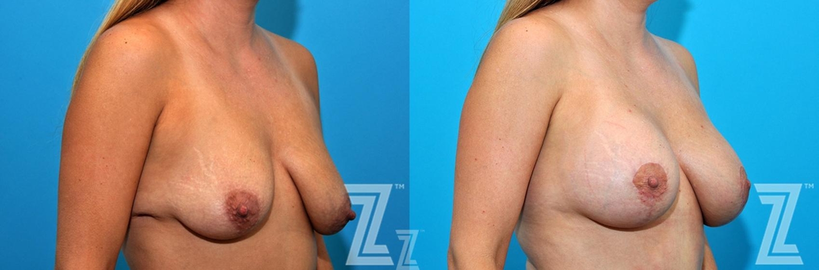Austin before and after images 36 year old woman 1 year post op mommy makeover oblique breast view - Austin Tx, The Piazza Center - The Piazza Center