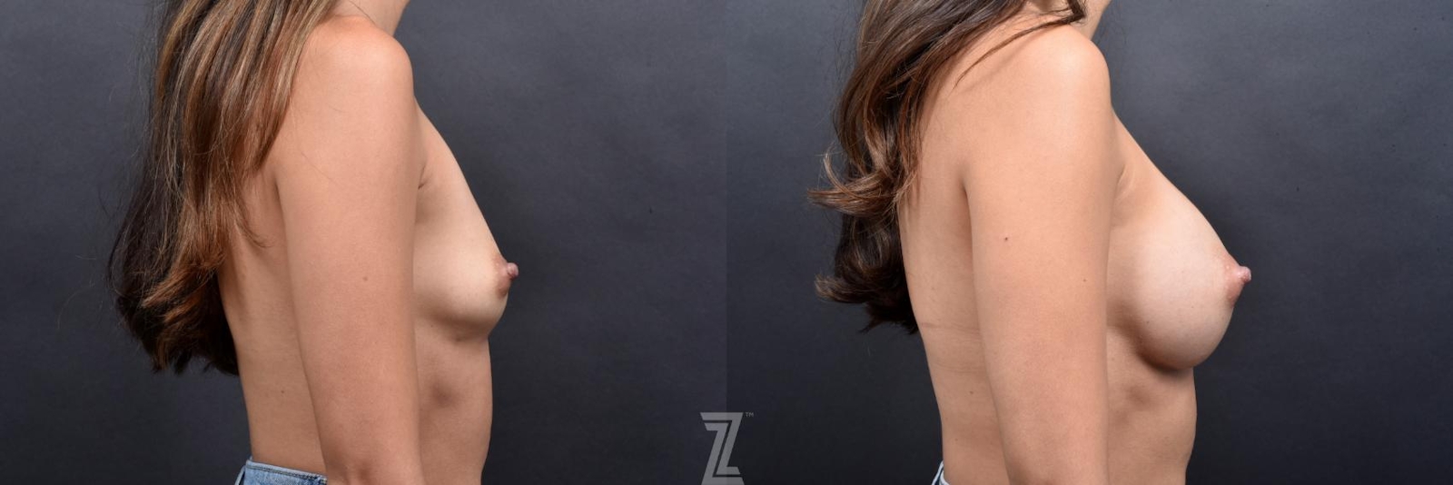 Austin Before & after side view of 30 year old woman with breast augmentation - Dr. Rocca Piazza - The Piazza Center