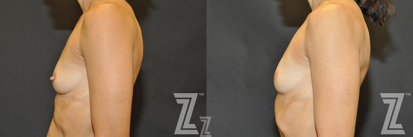 Austin Nipple Reduction Before & After Gallery - Patient 132886785 - Image 3 - The Piazza Center
