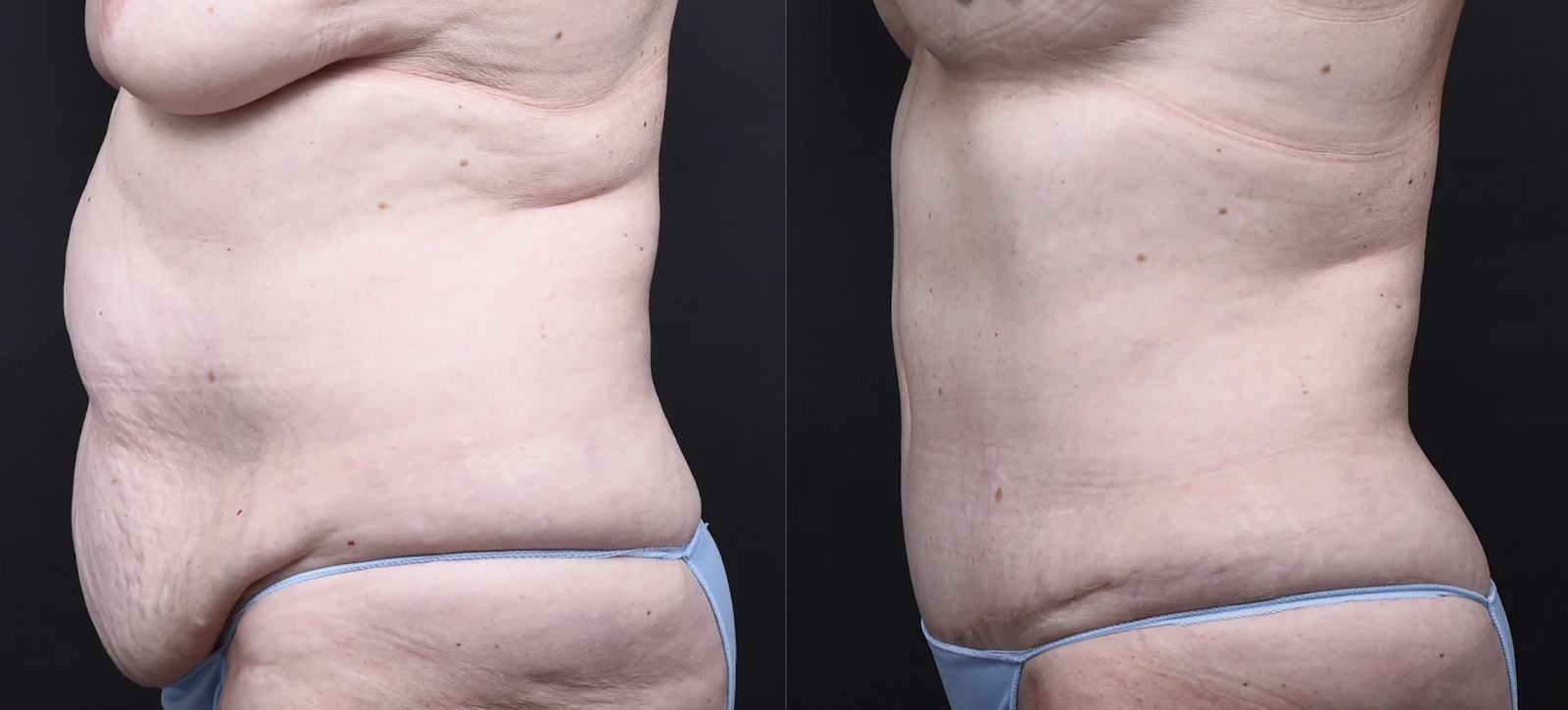 Austin Tummy Tuck Before & After Gallery - Patient 101511 - Image 2 - The Piazza Center