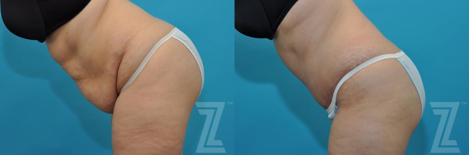 Austin Tummy Tuck Before & After Gallery - Patient 132886829 - Image 3 - The Piazza Center