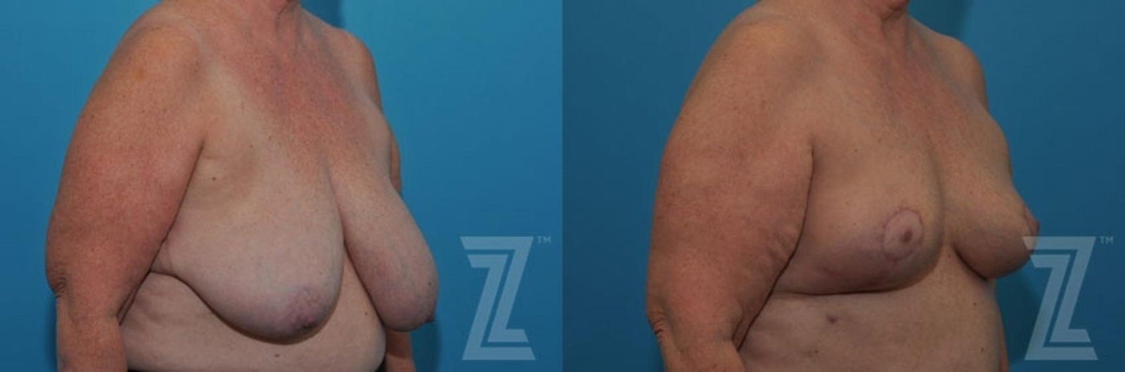 Austin Breast Reduction Before & After Gallery - Patient 132886611 - Image 4 - The Piazza Center