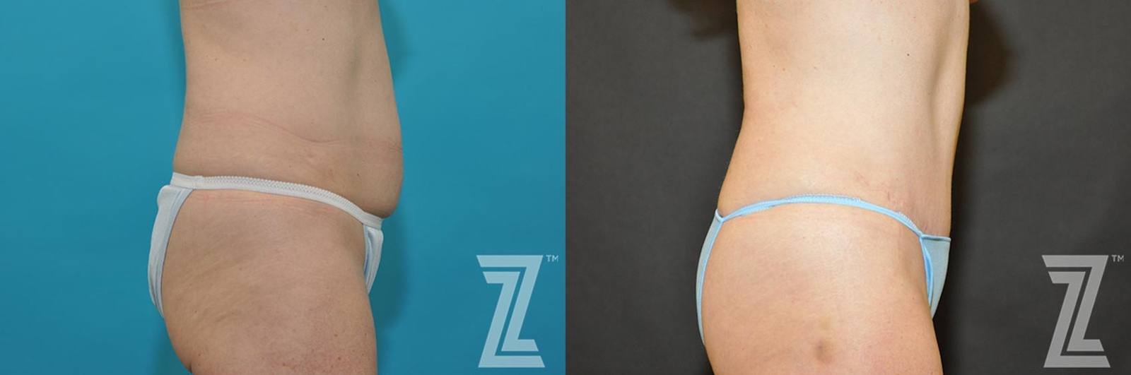 Austin Tummy Tuck Before & After Gallery - Patient 132886891 - Image 4 - The Piazza Center