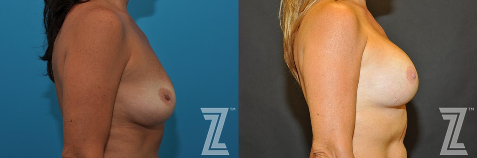 Austin Breast Augmentation Revision Before & After Gallery - Patient 132886563 - Image 5 - The Piazza Center