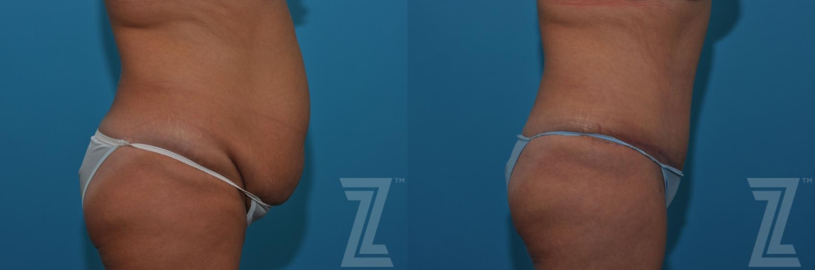 Austin Tummy Tuck Before & After Gallery - Patient 132886809 - Image 3 - The Piazza Center