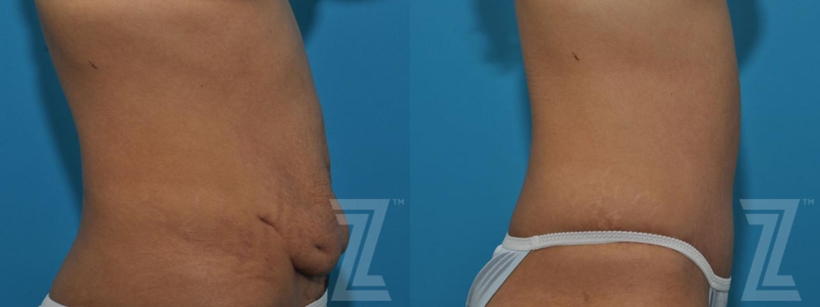 Austin Tummy Tuck Before & After Gallery - Patient 132886797 - Image 5 - The Piazza Center