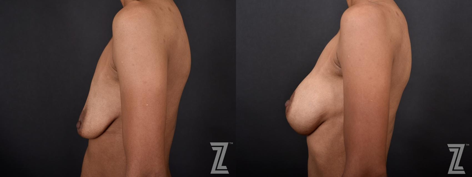 Austin Lateral View of Breast of 34-Year-Old Mom of Three Children Mommy Makeover Before & After by Dr. Rocco Piazza in Austin, Texas - The Piazza Center