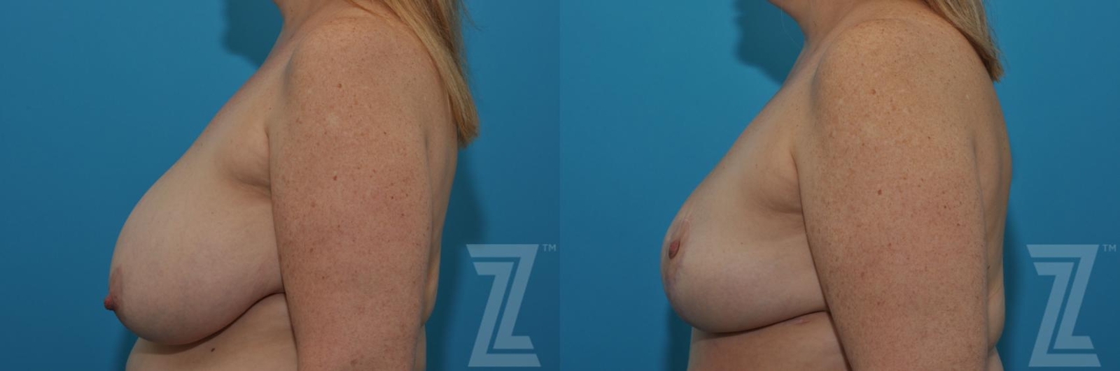 Austin Breast Reduction Before & After Gallery - Patient 132886750 - Image 1 - The Piazza Center