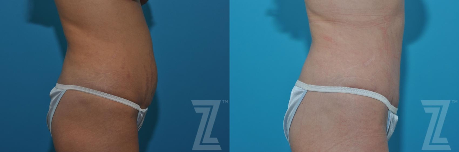 Austin Tummy Tuck Before & After Gallery - Patient 132886879 - Image 4 - The Piazza Center