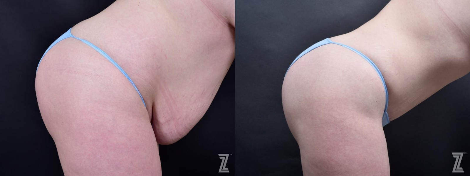 Austin Tummy Tuck Before & After Gallery - Patient 132886803 - Image 5 - The Piazza Center