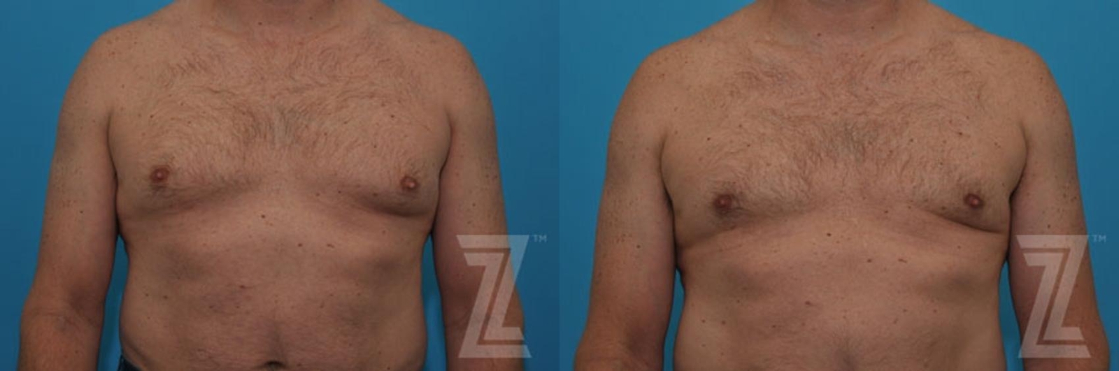 Austin Gynecomastia/Male Breast Reduction Before & After Gallery - Patient 115995 - Image 3 - The Piazza Center