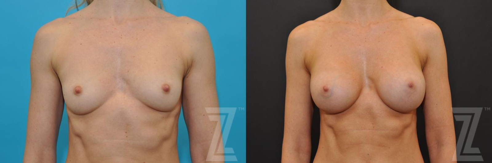 Austin Frontal View before and after of 36 year old woman with Silicone Implants with Highly Cohesive Gel (Gummy Bear Implants) - The Piazza Center - The Piazza Center