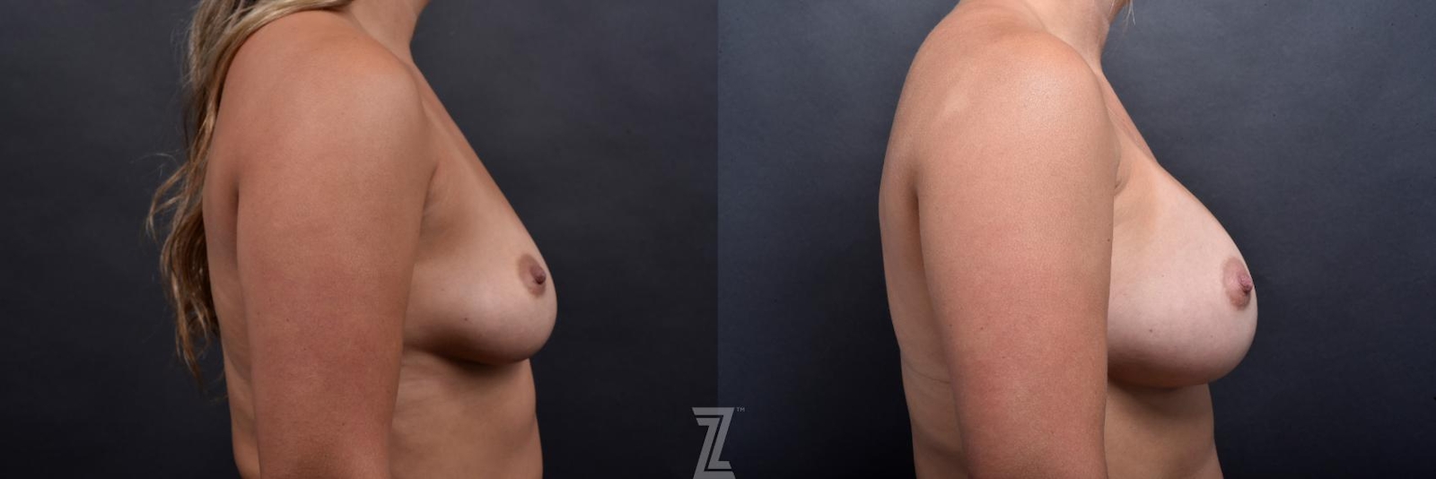 Austin Side view Before and after image of 27 year old woman with breast augmentation - Dr. Rocco C. Piazza - The Piazza Center