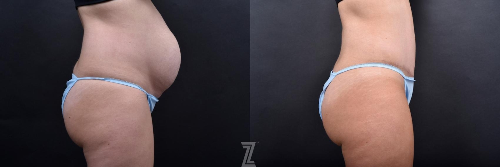 Austin Tummy Tuck Before & After Gallery - Patient 132886800 - Image 4 - The Piazza Center