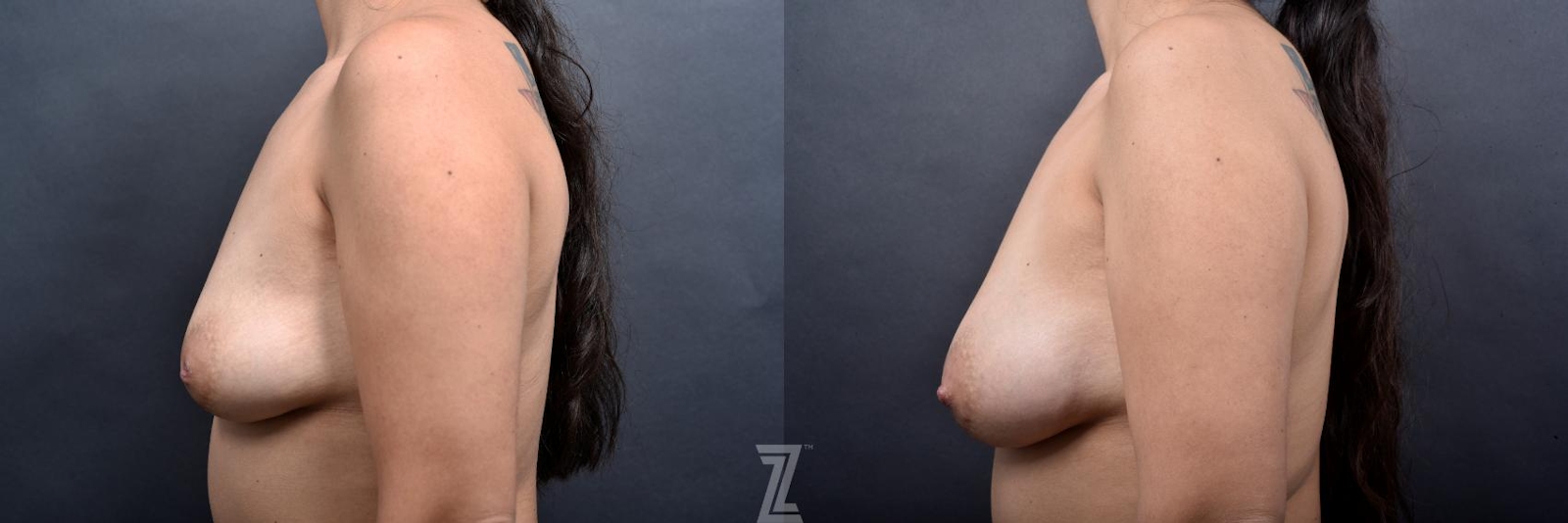 Austin Inverted Nipple Correction Before & After Gallery - Patient 132886790 - Image 3 - The Piazza Center