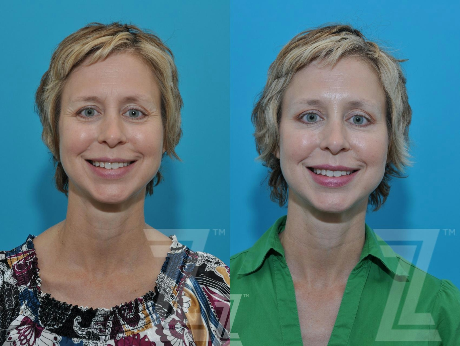 Austin Wrinkle Relaxers Before & After Gallery - Patient 132906319 - Image 1 - The Piazza Center
