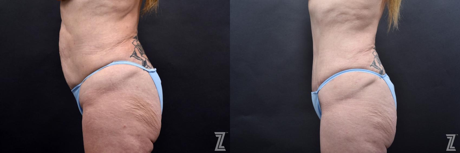 Austin Tummy Tuck Before & After Gallery - Patient 132886812 - Image 2 - The Piazza Center