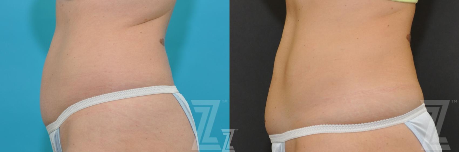 Austin CoolSculpting® Before & After Gallery - Patient 132905390 - Image 2 - The Piazza Center