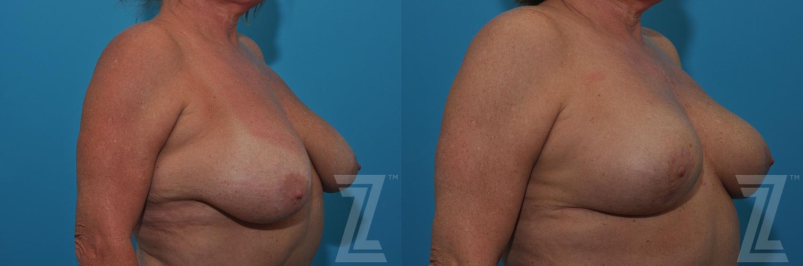 Austin Breast Lift Before & After Gallery - Patient 132791080 - Image 4 - The Piazza Center