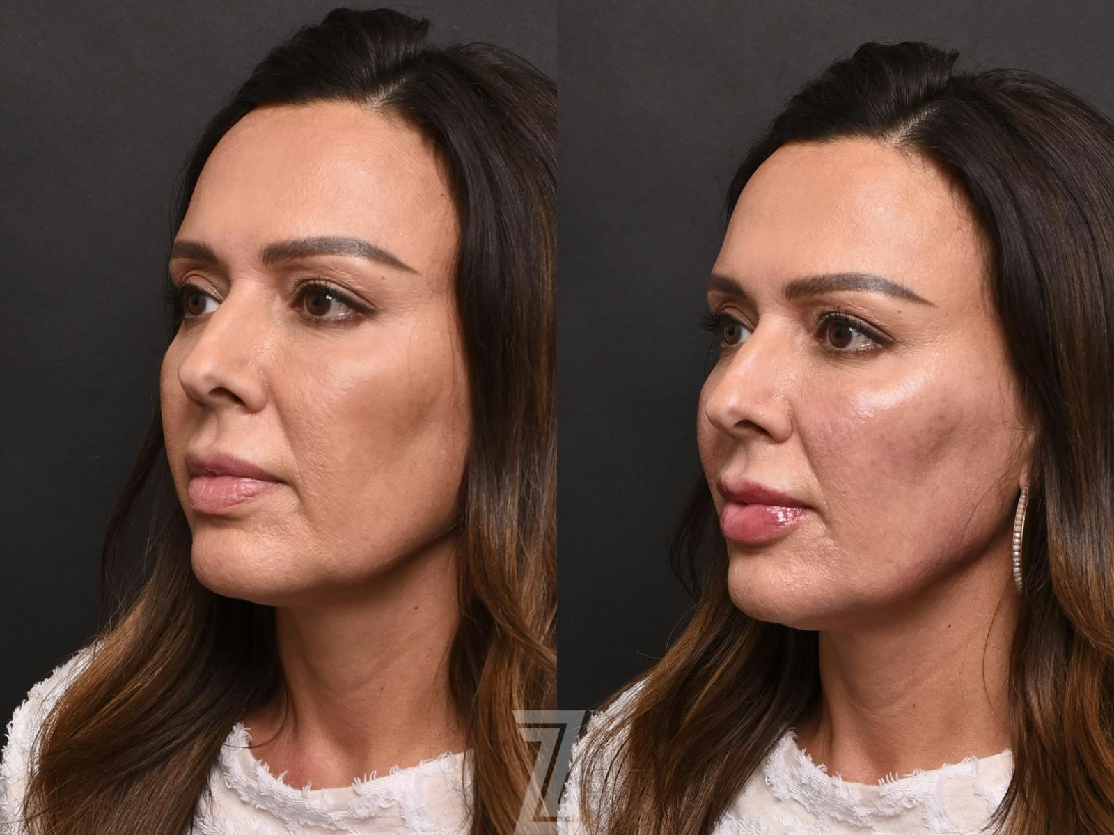 Austin Injectable Fillers Before & After Gallery - Patient 132963109 - Image 2 - The Piazza Center