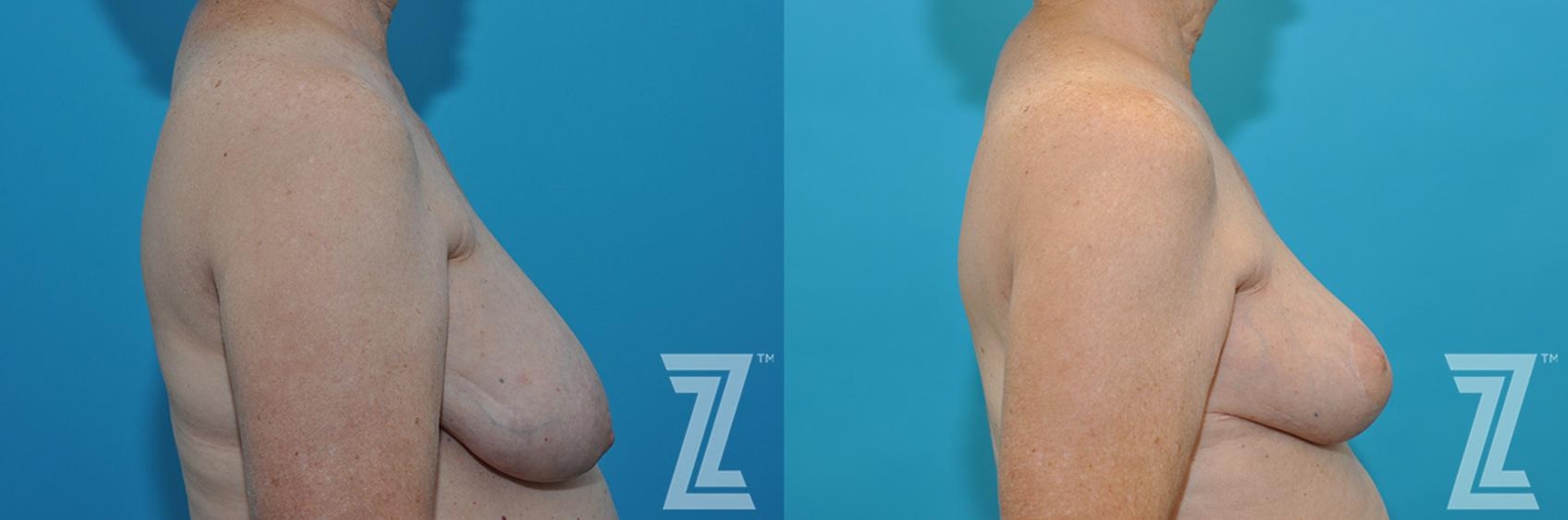 Austin Correction of Breast Asymmetry Before & After Gallery - Patient 132886776 - Image 5 - The Piazza Center