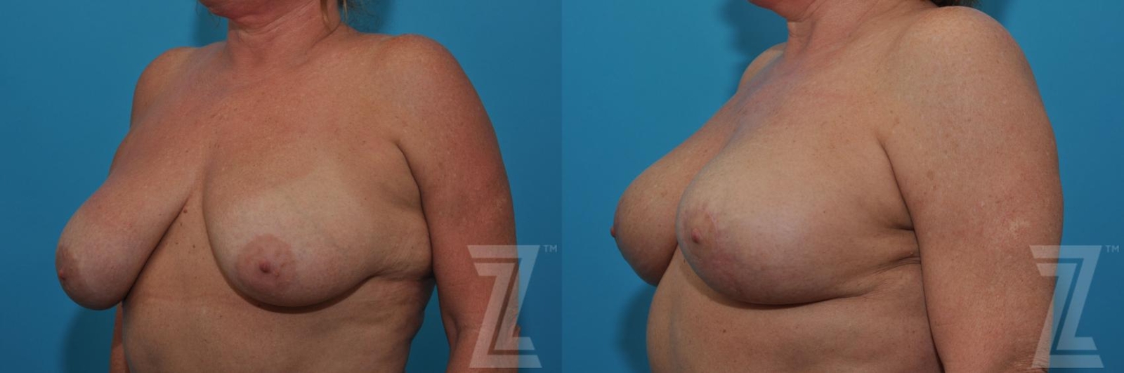 Austin Breast Lift Before & After Gallery - Patient 132791080 - Image 2 - The Piazza Center